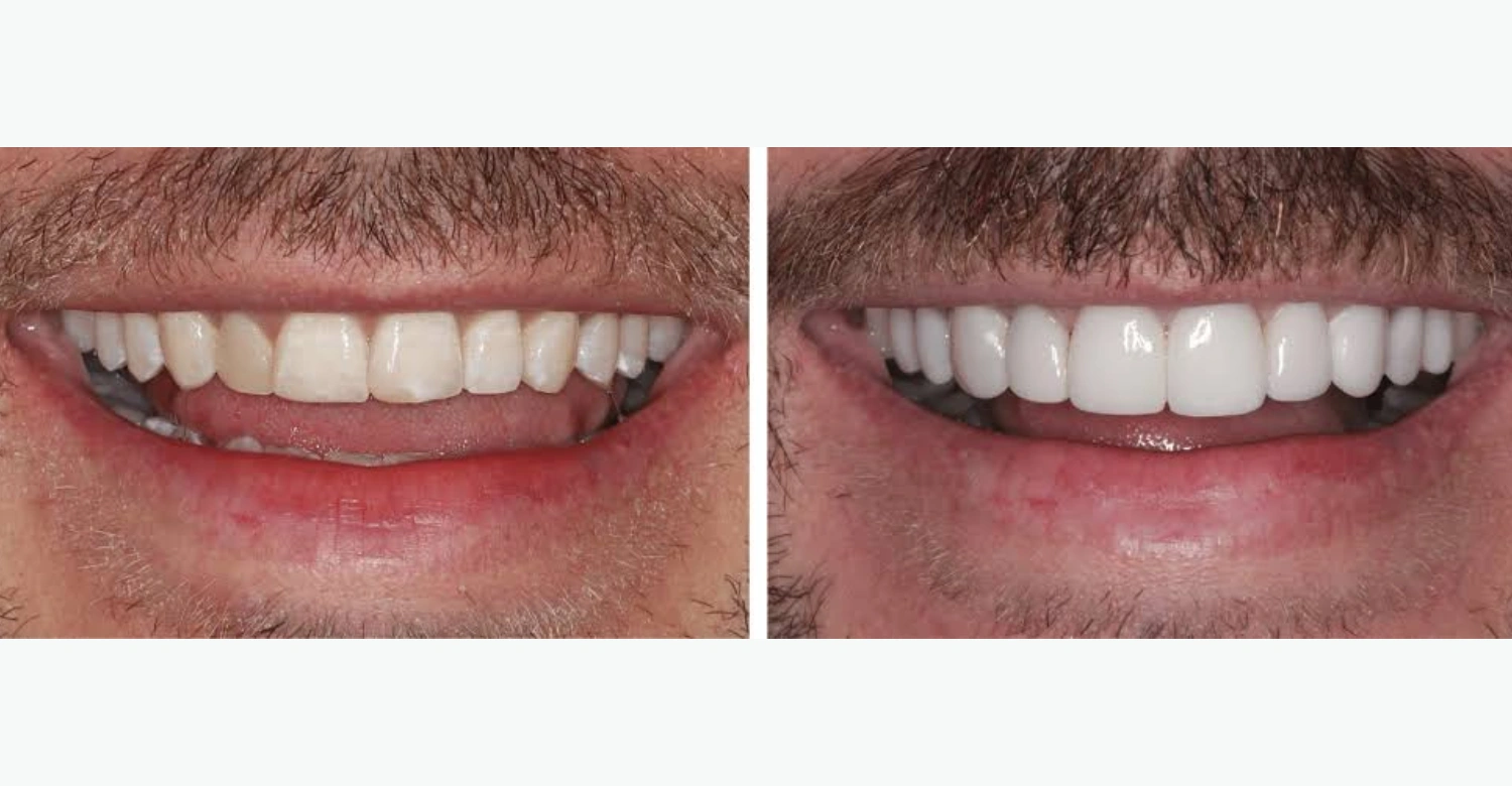 Veneers Turkey Package inblog